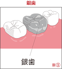 ※① 銀歯