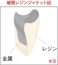 ※③ 硬質レンジジャケット冠